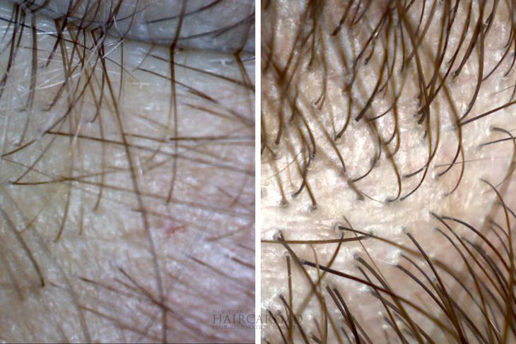 Close up showing a real patient hair transplant progress