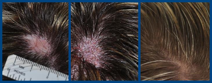 Photo showing bald spot repair