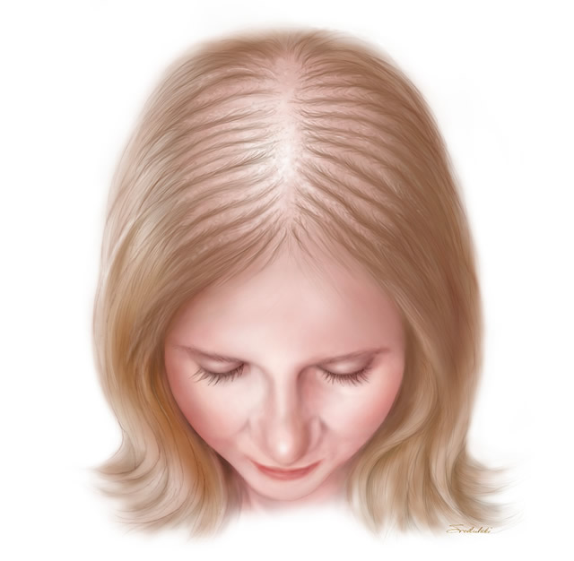 Illustration showing extensive hair loss in the hairline