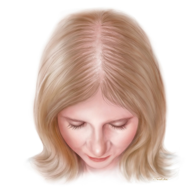 Illustration showing moderate hair loss