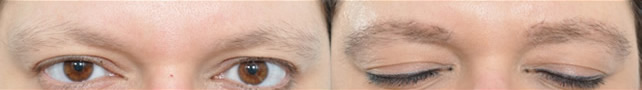 Before and after real patient photos eye surgery