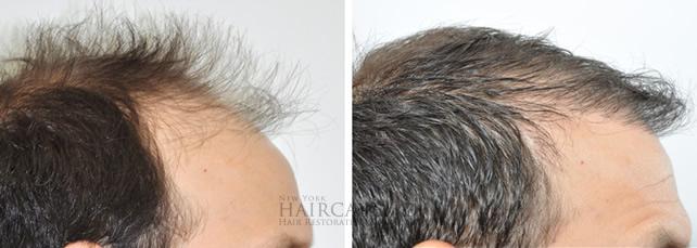 Real patient photo - hair transplant