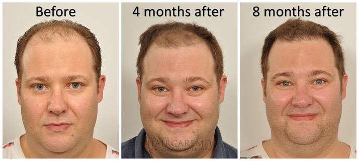 Real patient hair transplant progression