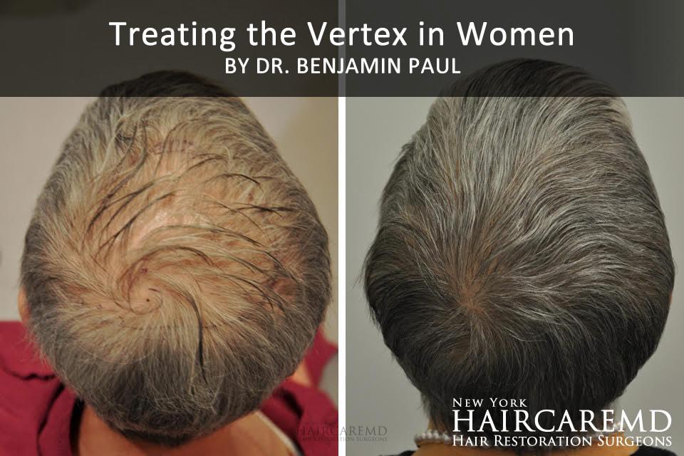 Before and after patient treating the vertex in women in NYC
