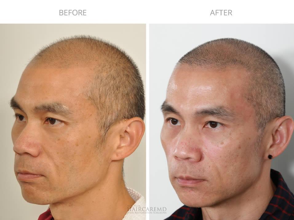 Real patient progress before and after hair transplant