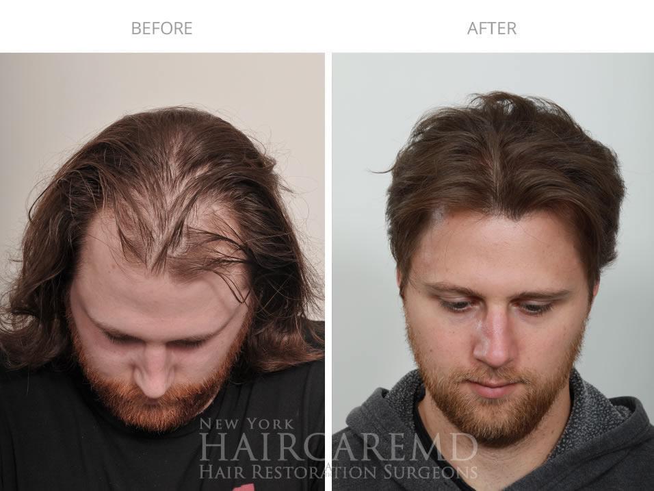 Real patient 3 year results after hair transplant