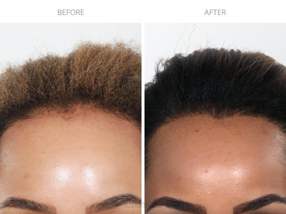 Front view of a real patient before and after thinning hairline progress photo