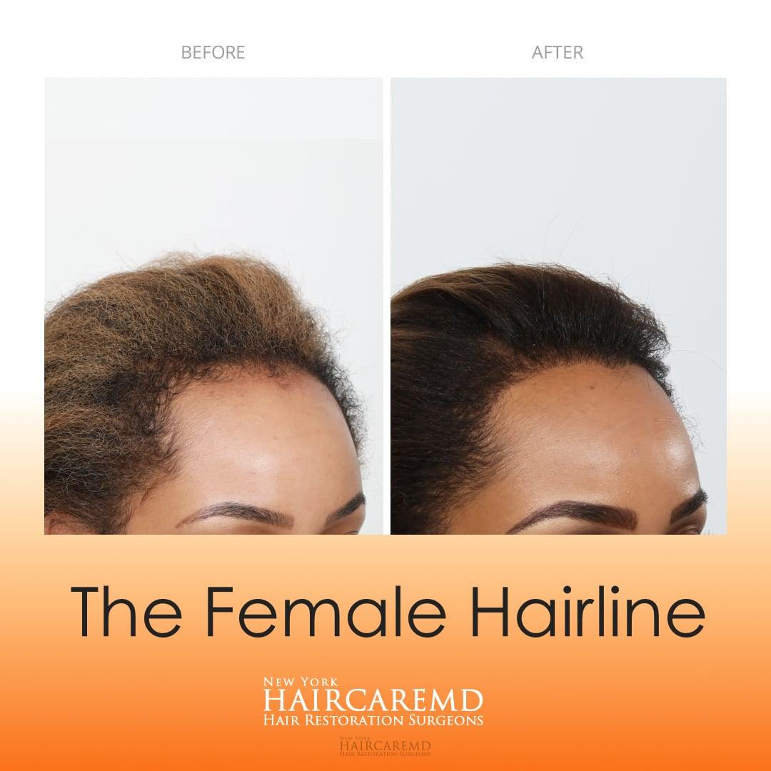 Before and after thinning hair line results on a real female patient