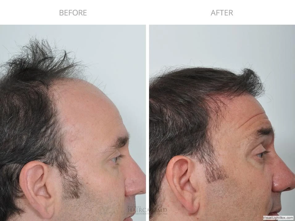 Male Hair Transplant