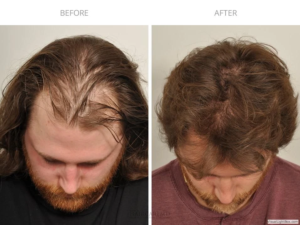 Male Hair Transplant