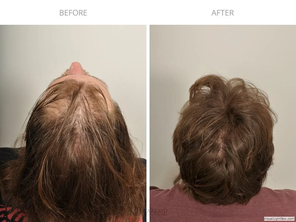 Male Hair Transplant