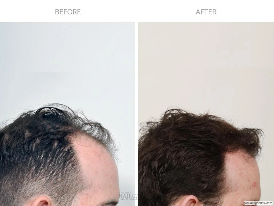 Male Hair Transplant