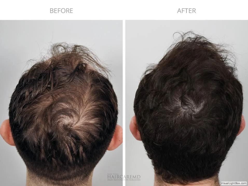 Male Hair Transplant