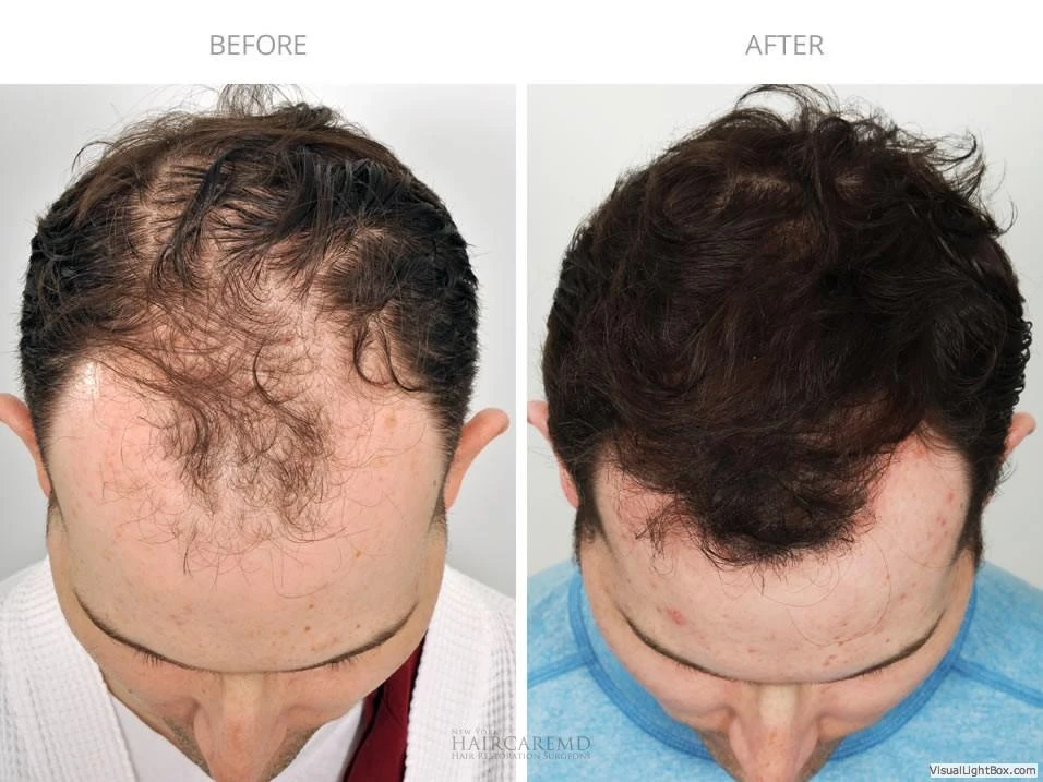 Male Hair Transplant