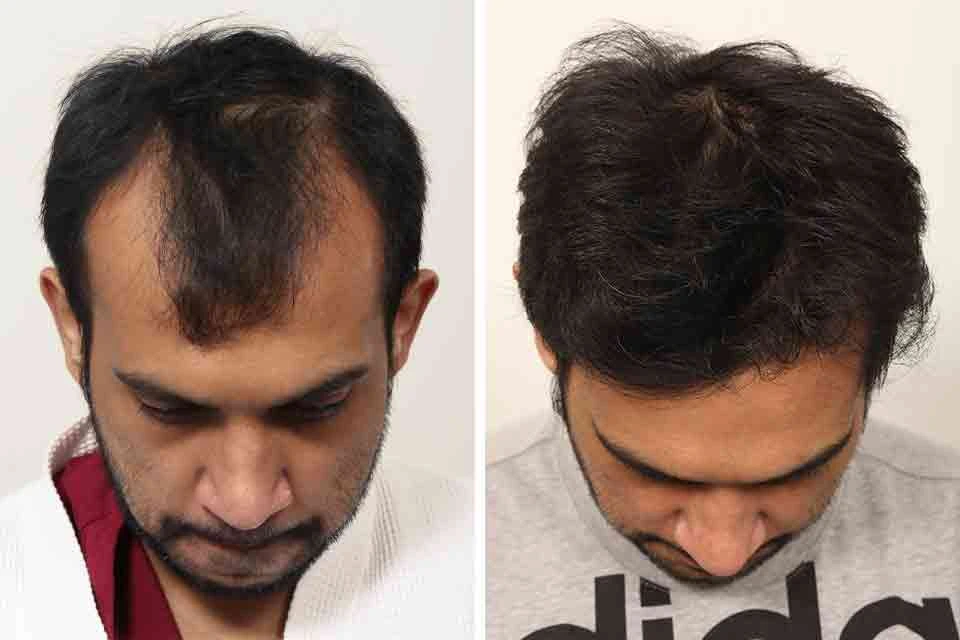 Male Hair Transplant