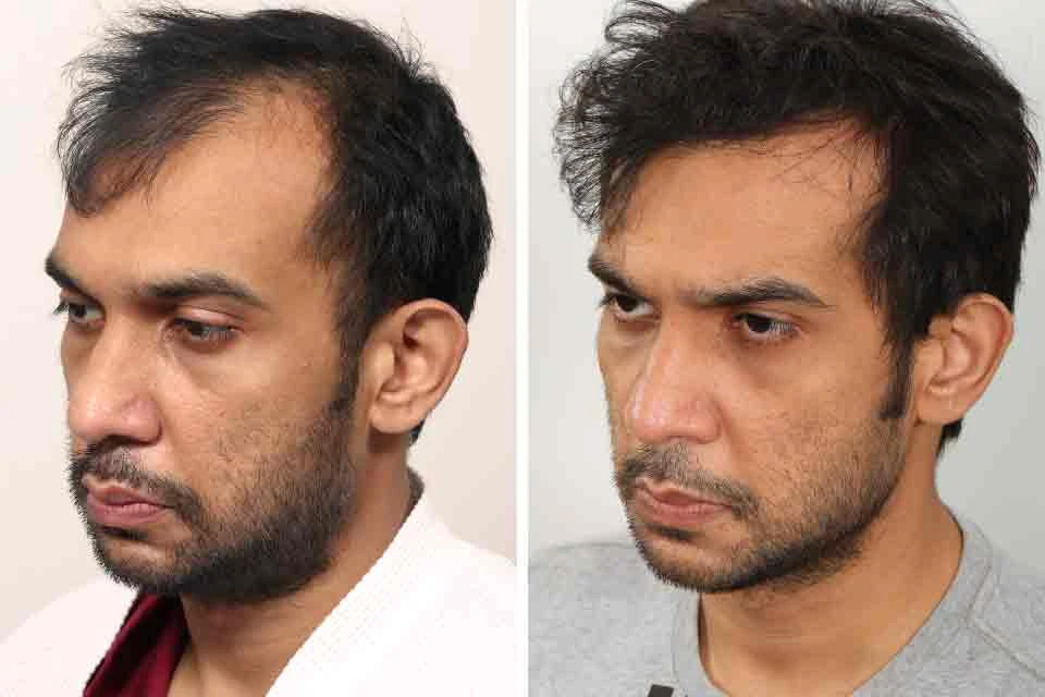 Male Hair Transplant