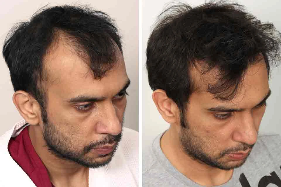 Male Hair Transplant