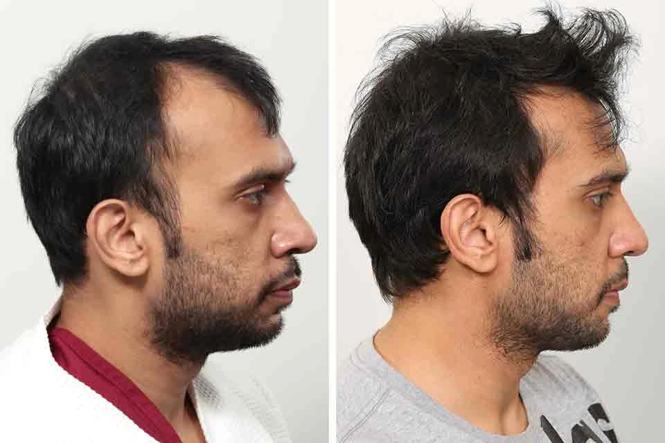 Male Hair Transplant