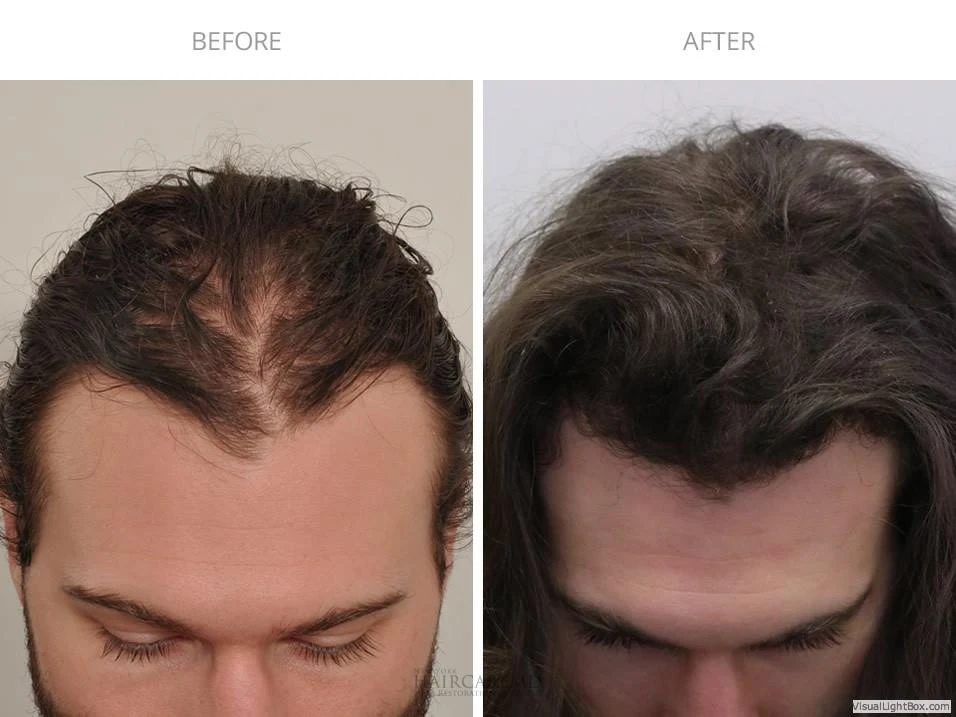 Male Hair Transplant