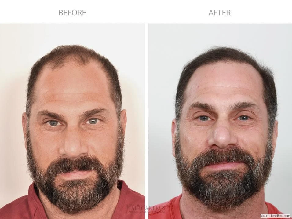 Male Hair Transplant