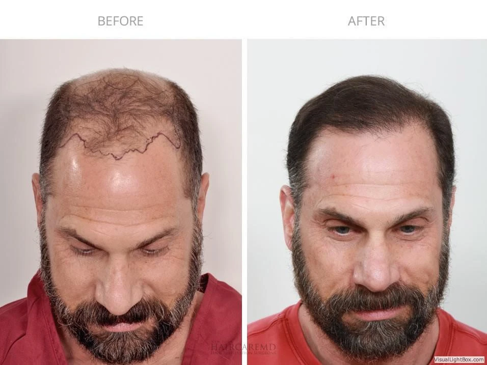 Male Hair Transplant