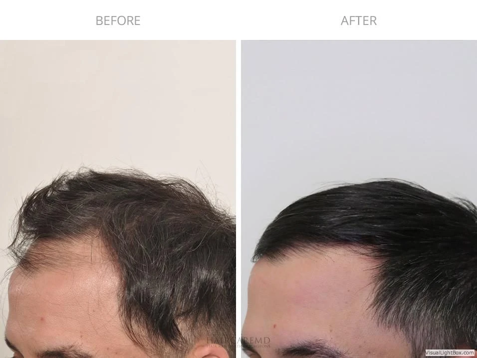 Male Hair Transplant