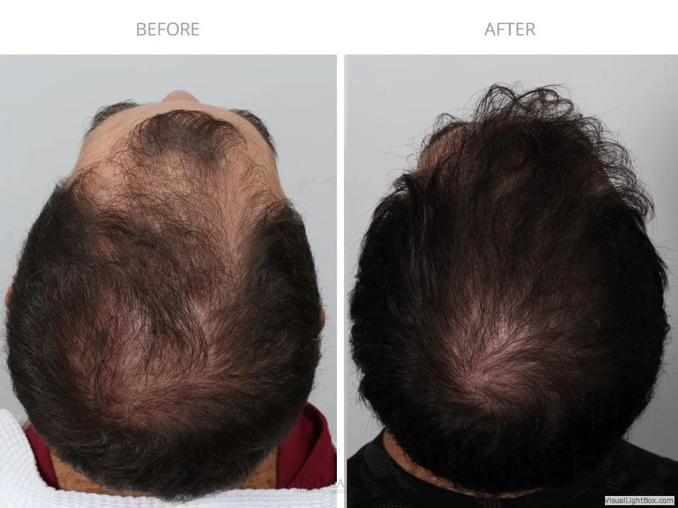 Male Hair Transplant