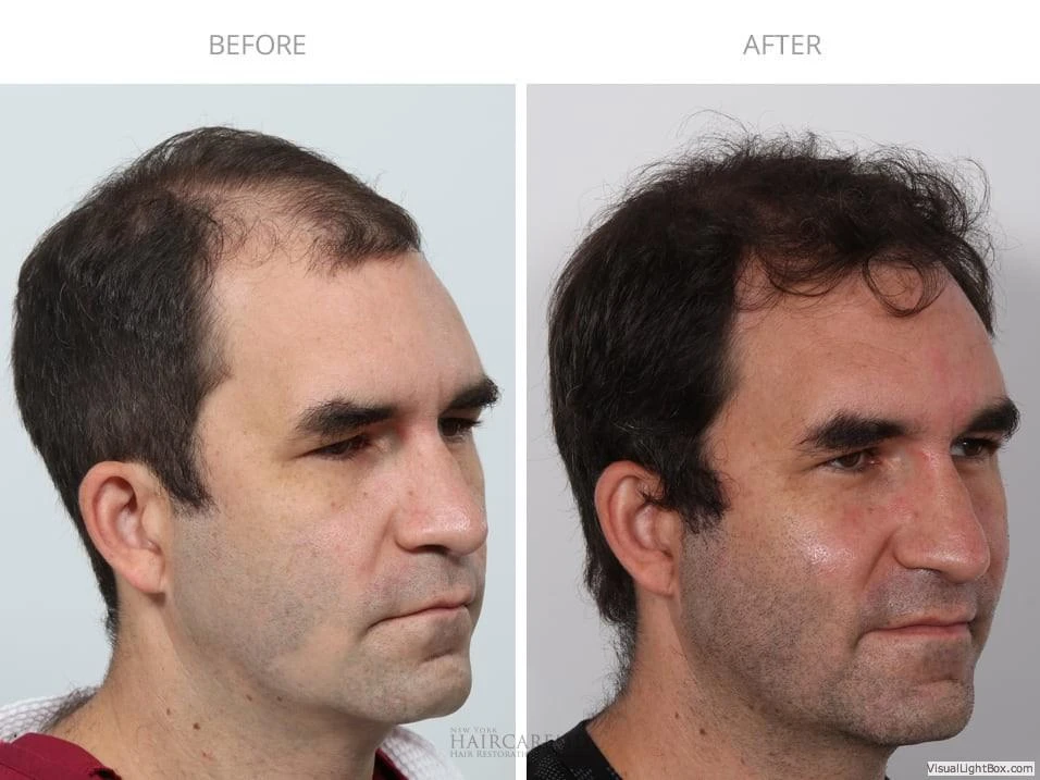 Male Hair Transplant