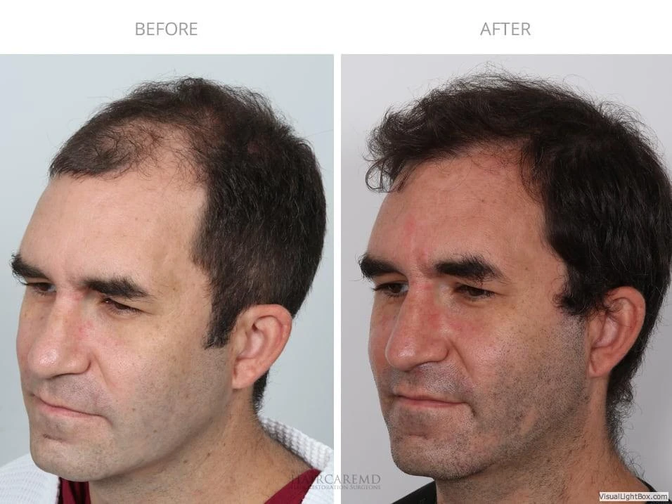 Male Hair Transplant