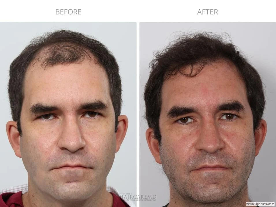 Male Hair Transplant