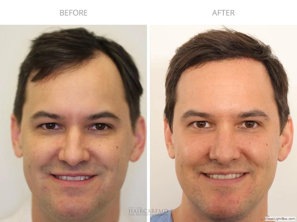 Male Hair Transplant