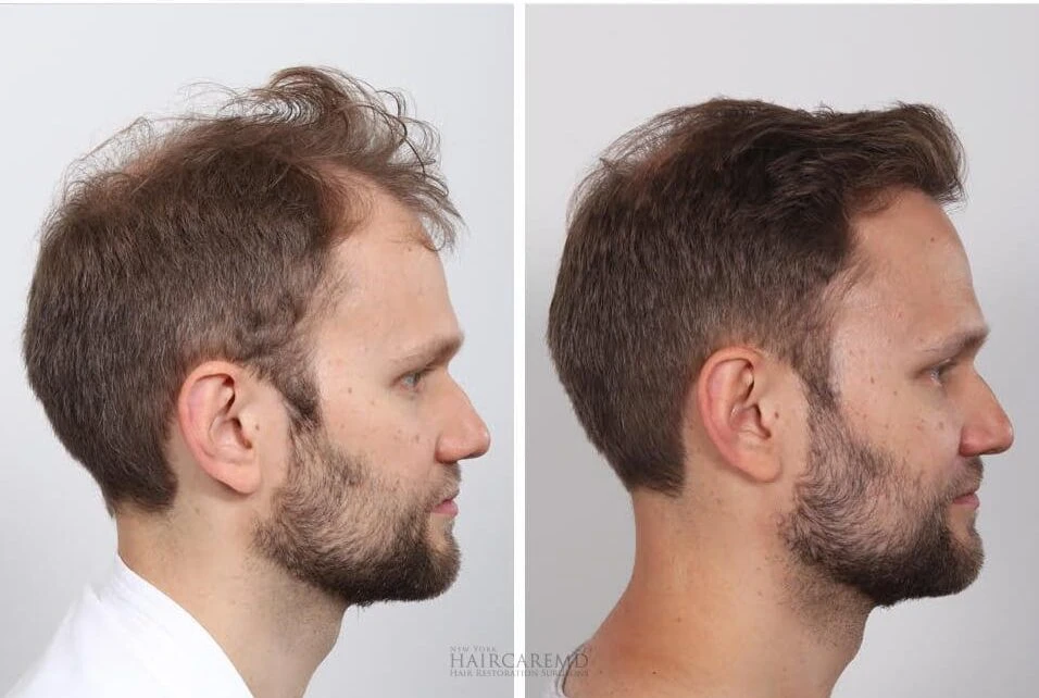 Male Hair Transplant