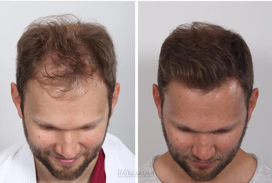 Male Hair Transplant