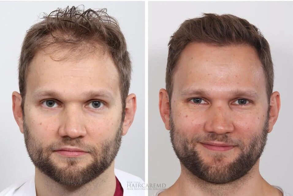 Male Hair Transplant