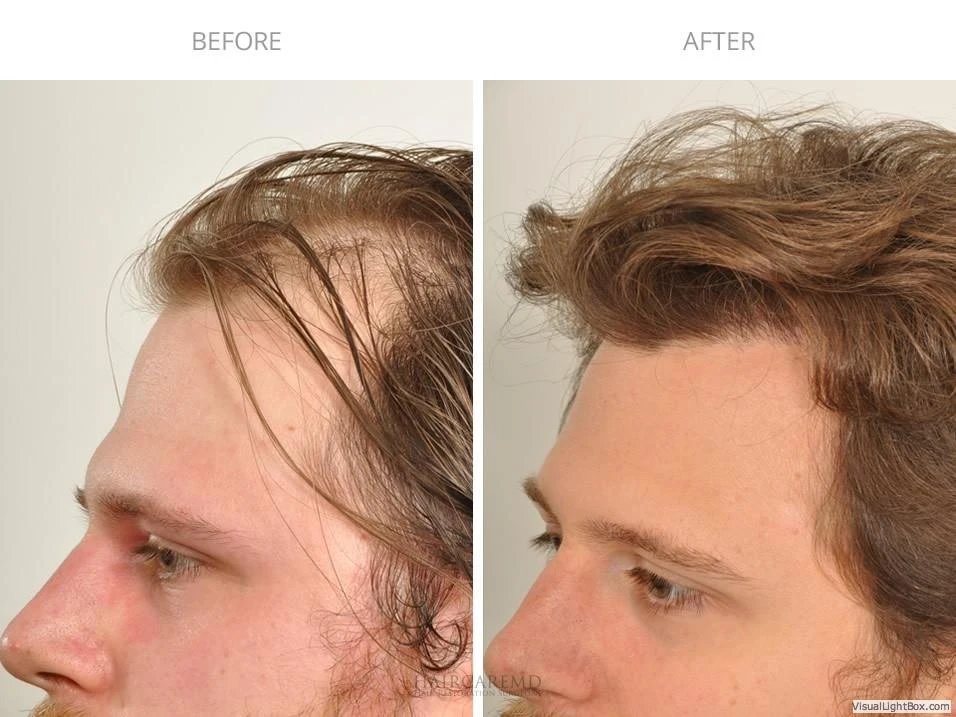 Male Hair Transplant