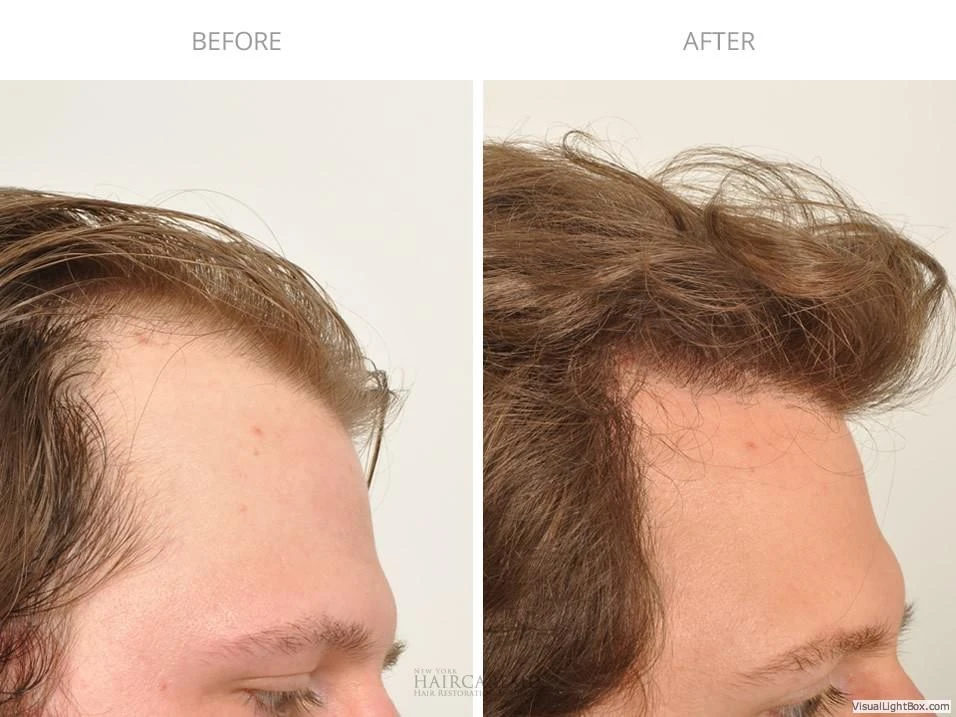 Male Hair Transplant