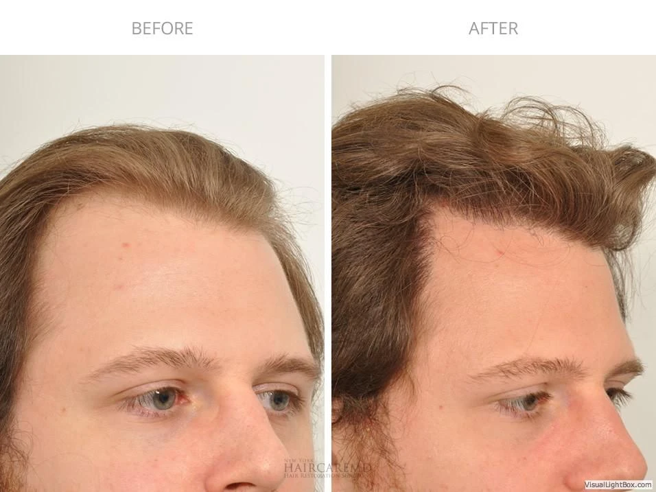 Male Hair Transplant