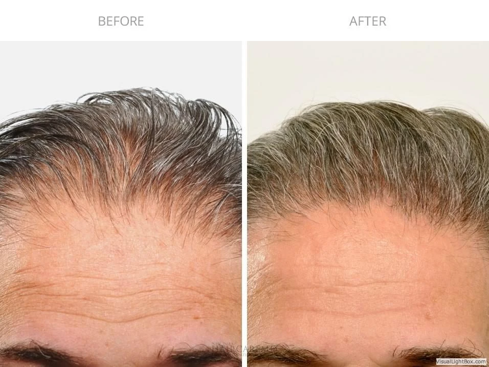 Male Hair Transplant