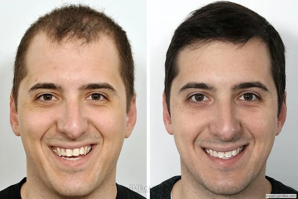 Male Hair Transplant