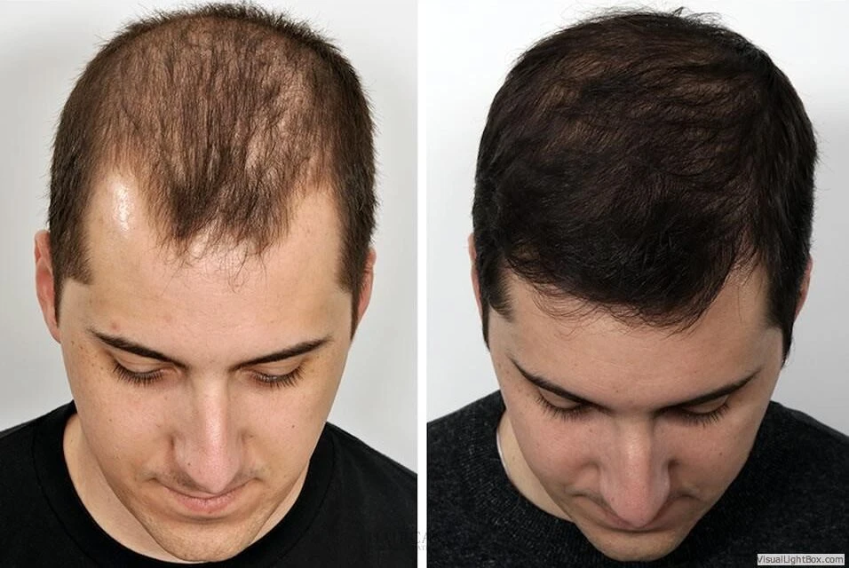 Male Hair Transplant