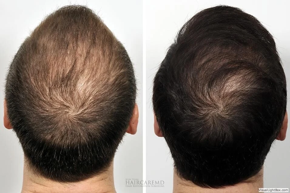 Male Hair Transplant