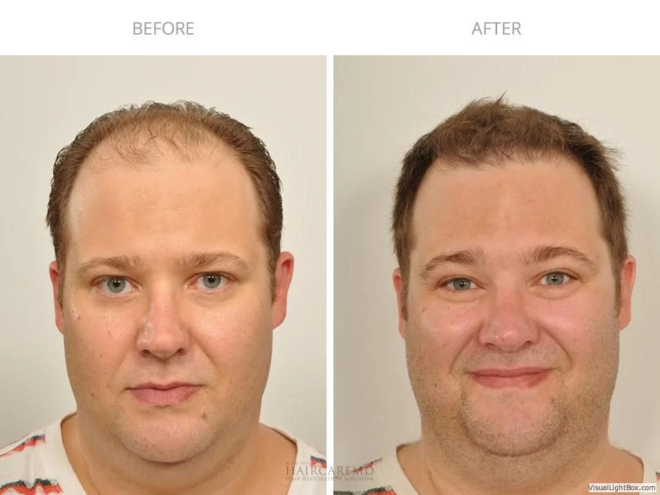 Male Hair Transplant