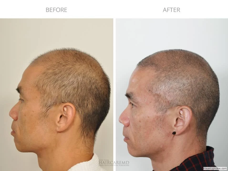 Male Hair Transplant