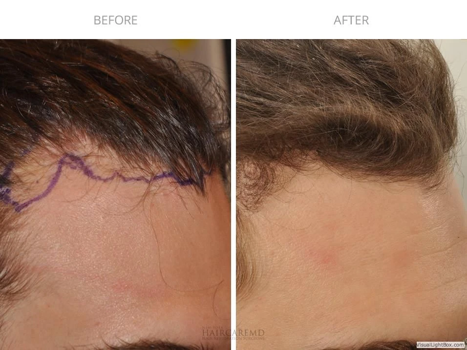 Male Hair Transplant