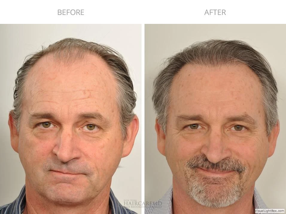 Male Hair Transplant