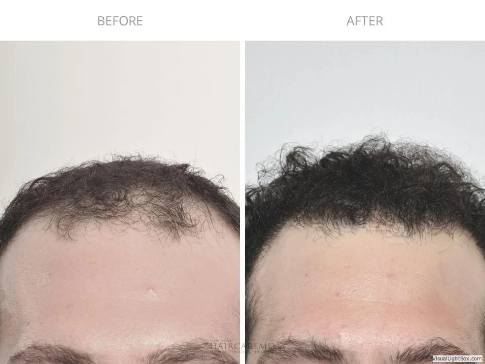 Male Hair Transplant