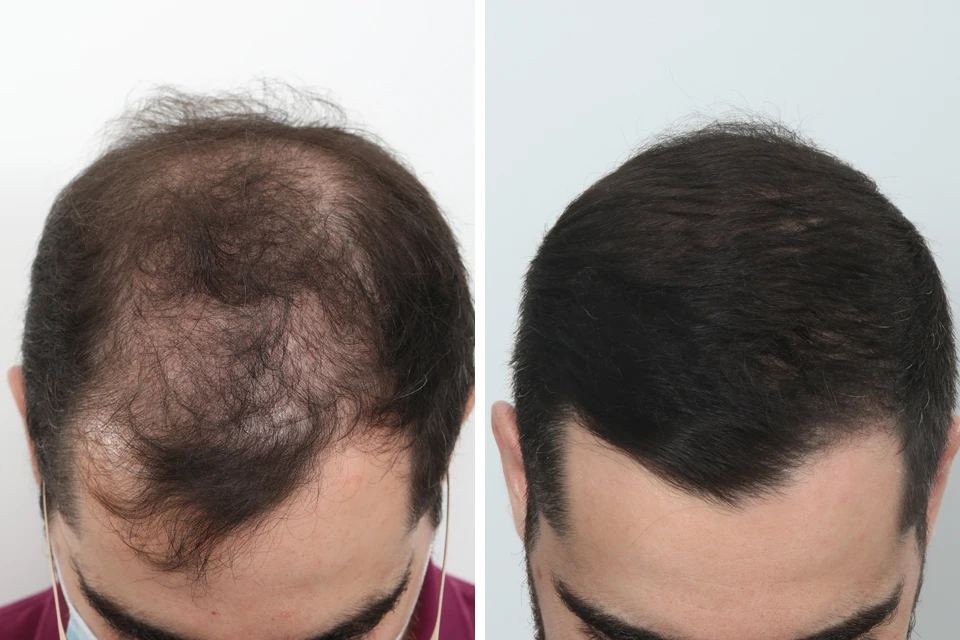 Male Hair Transplant