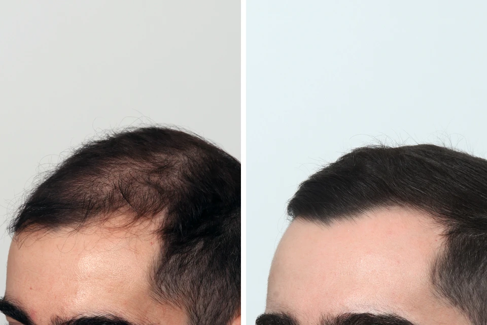 Male Hair Transplant