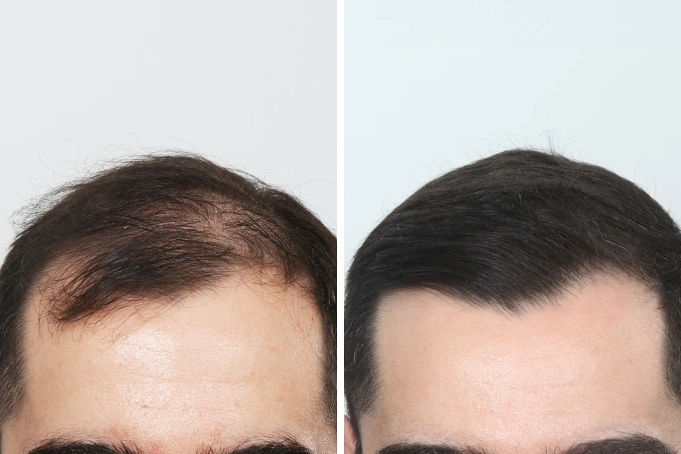 Male Hair Transplant