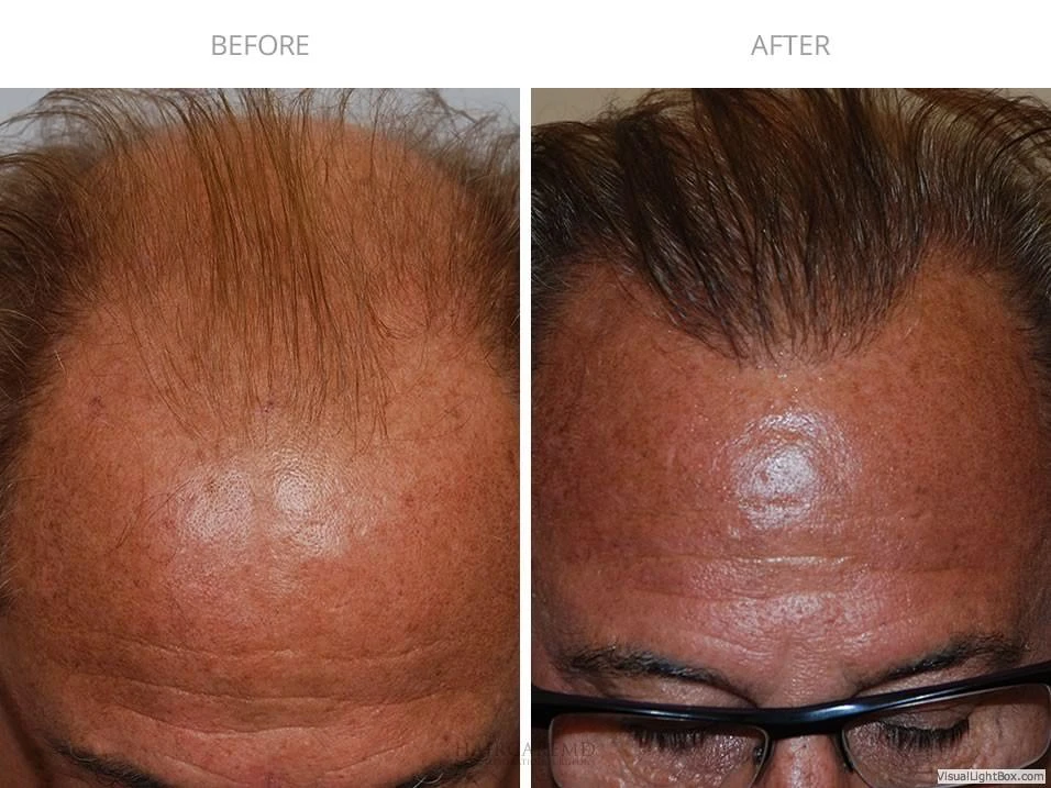 Male Hair Transplant